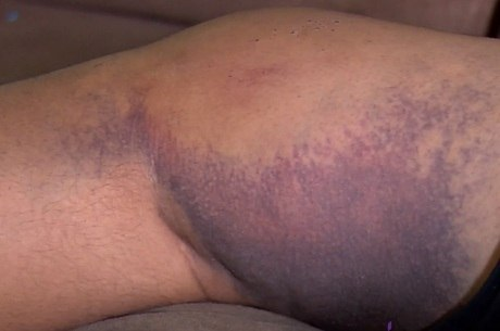 Motorista de aplicativo continua com hematomas pelo corpo