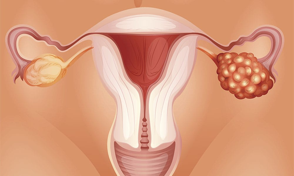 Endometriose, o que é? Sintomas, consequências, tratamento, prevenção