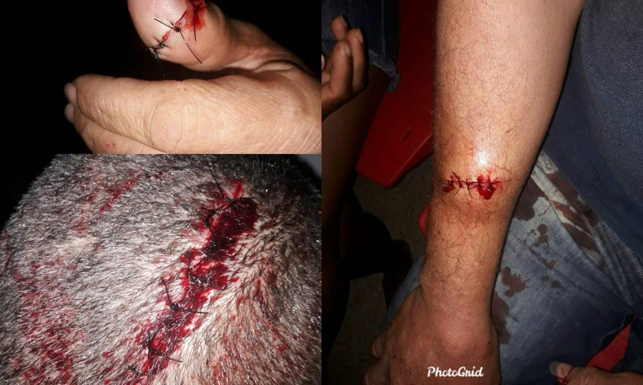 Briga entre cunhados deixa um ferido a facãozadas na Portelinha, em Medeiros