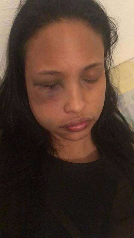 Bianca sofreu fraturas nos ossos da face
