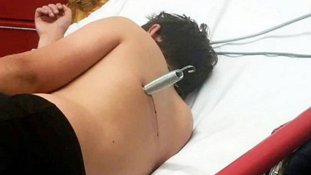 'Como uma bala': mola fica cravada nas costas de adolescente