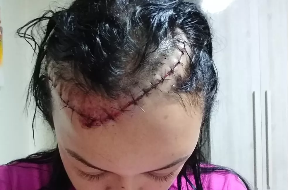 Rafaele Christina Melo de Almeida foi levada para o hospital e levou 40 pontos na cabeça — Foto: Arquivo pessoal Rafaele Christina Melo de Almeida foi levada para o hospital e levou 40 pontos na cabeça — Foto: Arquivo pessoal