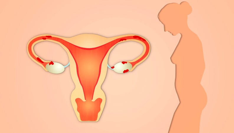 Endometriose, o que é? Sintomas, tratamento e prevenção