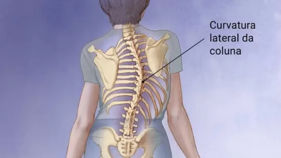 A ESCOLIOSE segundo Dr. Leonardo Felipe. complicações e tratamentos