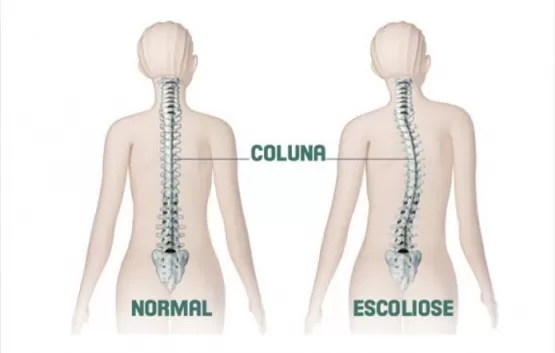 A ESCOLIOSE segundo Dr. Leonardo Felipe. complicações e tratamentos