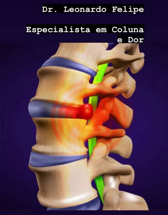 A ESCOLIOSE segundo Dr. Leonardo Felipe. complicações e tratamentos