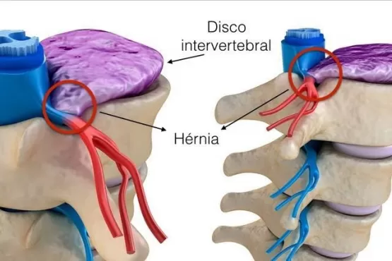 Vamos Falar Sobre hérnia de disco .. Dr Leonardo Felipe explica como aliviar os sintomas
