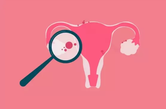 Endometriose: conheça as causas, os sintomas e os tratamentos