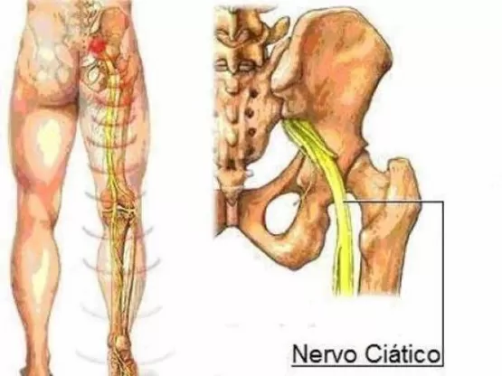 Dr. Leonardo esclarece sobre uma das lesões mais comuns da coluna lombar (Ciatalgia), ou seja, dor no nervo ciático
