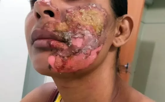 Mateus da Costa Miranda de 23 anos foi preso por Investigadores da polícia civil de Itamaraju, nesta terça-feira, 06 de dezembro, sob a acusação de agredir e ameaçar sua companheira Neliane Silva do Nascimento de 28 anos.  À polícia, Neliane contou que o companheiro chegou em casa embriagado e ela questionou a situação. Em seguida, foi agredida com um tapa no rosto. Ela disse ainda na delegacia de Itamaraju que depois do tapa, o homem foi até a cozinha, colocou óleo de soja para esquentar. Com um facão e com a panela de óleo na mão, ele jogou o óleo quente no rosto dela e desferiu um golpe de facão que lhe atingiu o pescoço, causando um corte. O homem ainda destruiu o aparelho celular de Neliane. Diante das evidências uma diligência com autorização do delegado Gilvan de Meireles Prates, foi até a casa do agressor, conseguindo localiza-lo e efetuar a prisão. Mateus prestou depoimento ao delegado e poderá ser indiciado por tentativa de feminicídio. Ele está detido na DEPOL de Itamaraju e ficará à disposição da justiça.