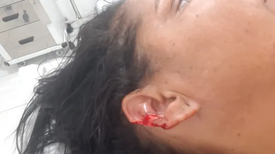 Mulher tem pedaço da orelha arrancada pelo marido após ele ter ataque de fúria