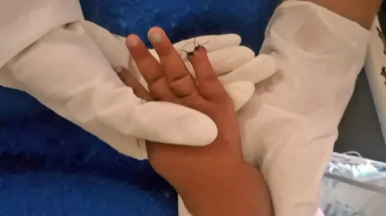 Bebê tem parte do dedo amputada após erro de enfermeira