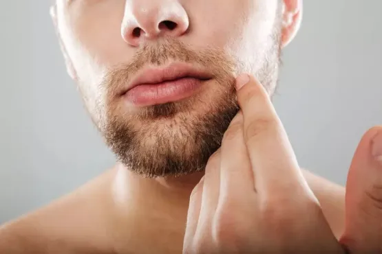 5 dicas para quem tem espinhas na região da barba