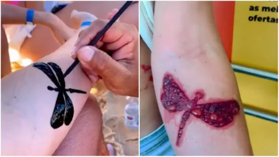 Tatuagem de henna é comum no verão, mas oferece riscos à pele  
