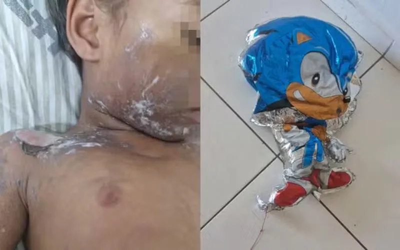 Menino de 3 anos sofre queimaduras graves após balão de gás explodir em Porto Seguro