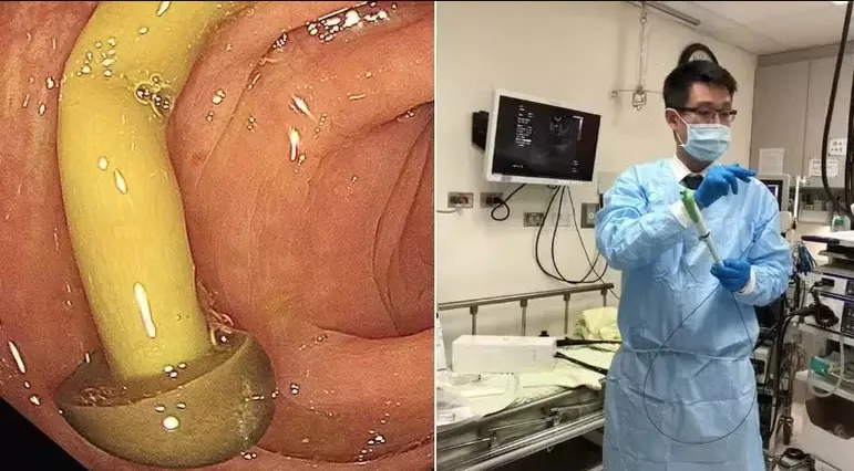 Médico encontra cogumelo crescendo em intestino de paciente; entenda