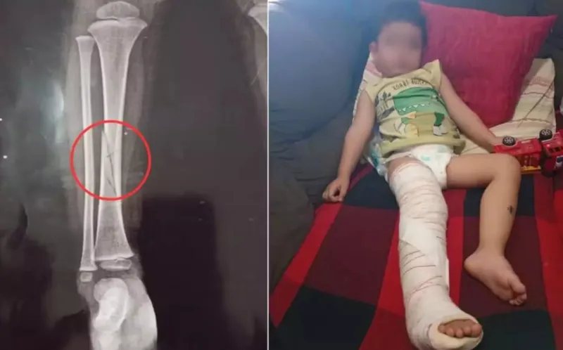 Briga por brinquedo em creche termina com menino com a perna quebrada