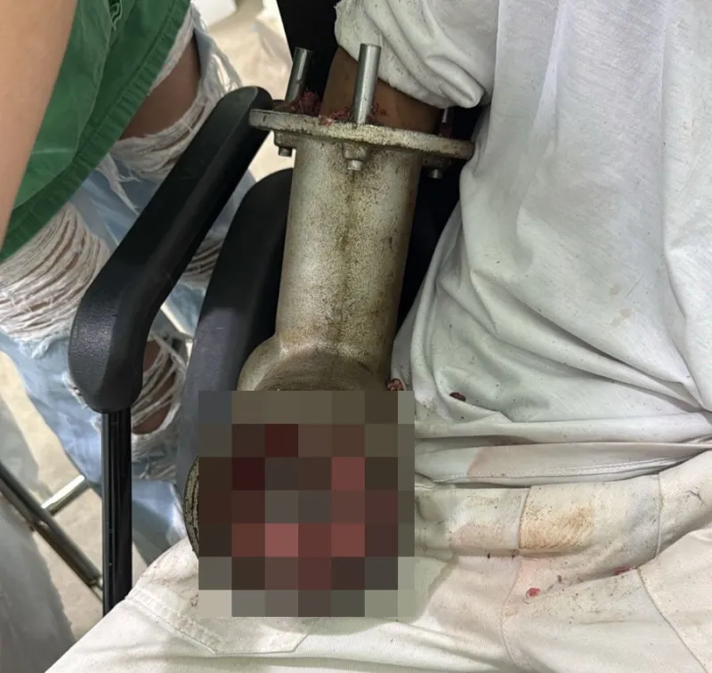 Açougueiro tem mão triturada em máquina de moer carne em supermercado no ES Açougueiro tem mão triturada em máquina de moer carne em supermercado no ES