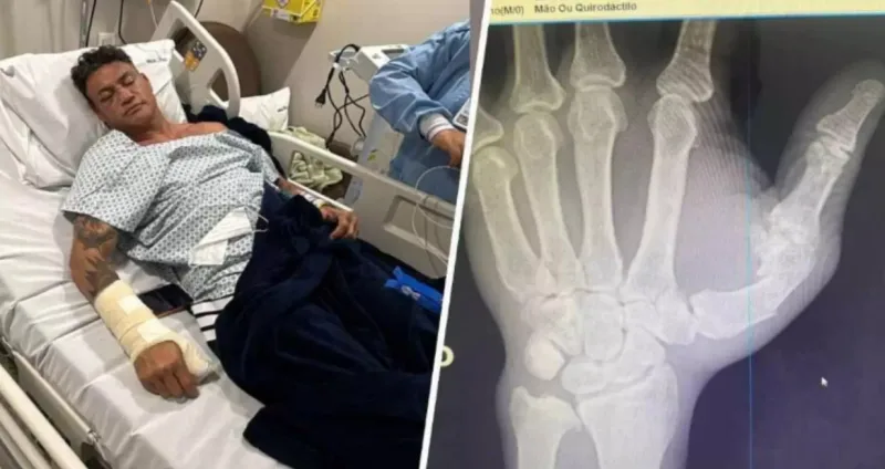 Popó passa por cirurgia após sangramento interno e fratura na mão durante briga generalizada com Wanderlei Silva 