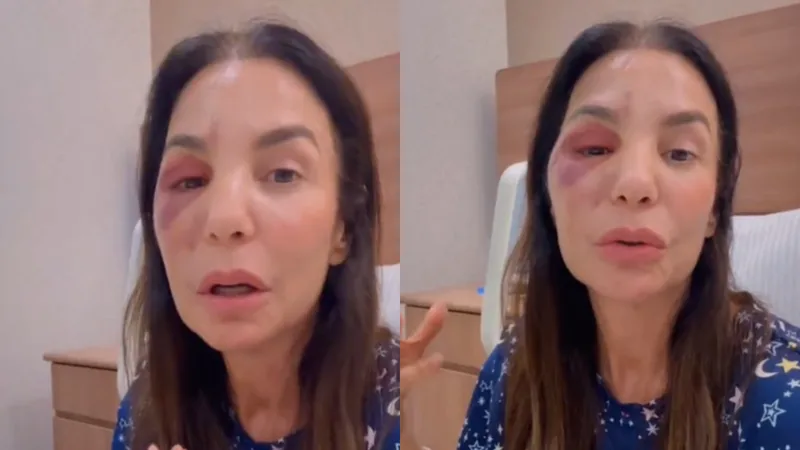 Ivete Sangalo comenta cirurgia no rosto após queda no banheiro: 'Quebrei dois ossos'  