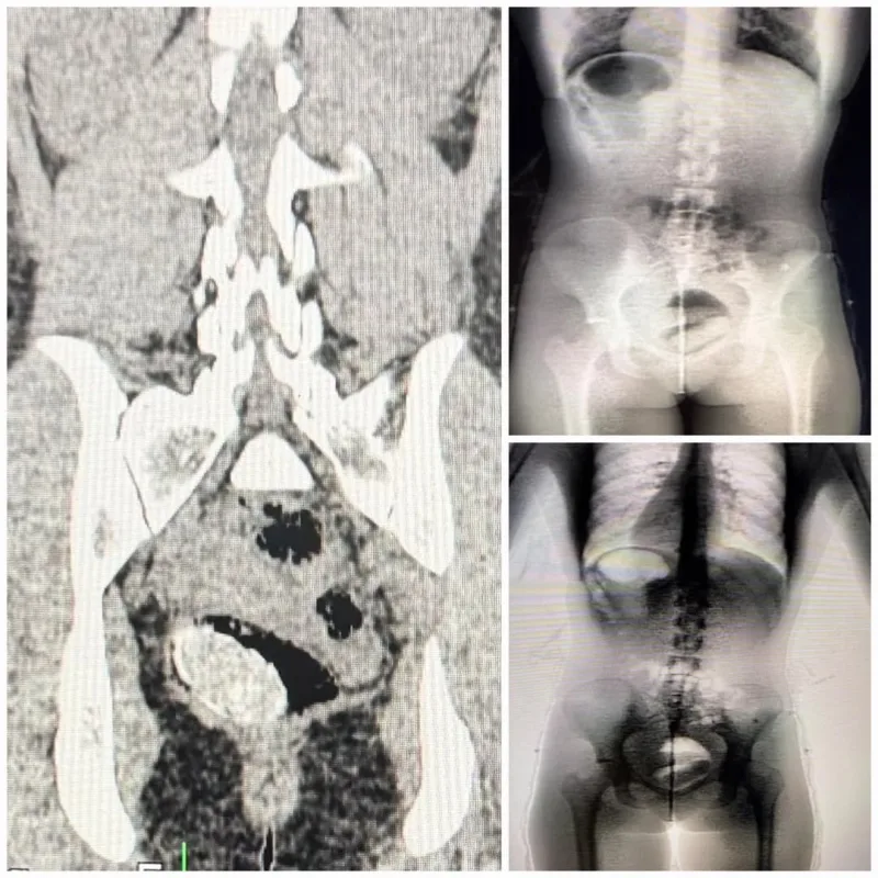 Mulher é presa após Body Scan apontar material ilícito em unidade prisional da Bahia Mulher é presa após Body Scan apontar material ilícito em unidade prisional da Bahia