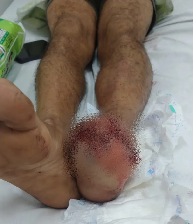 Homem fica gravemente ferido após pisar em artefato explosivo durante brincadeira em Rondônia Homem fica gravemente ferido após pisar em artefato explosivo durante brincadeira em Rondônia