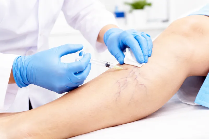 Alcobaça realiza mutirão de escleroterapia para tratamento de varizes e amplia acesso à saúde especializada Alcobaça realiza mutirão de escleroterapia para tratamento de varizes e amplia acesso à saúde especializada