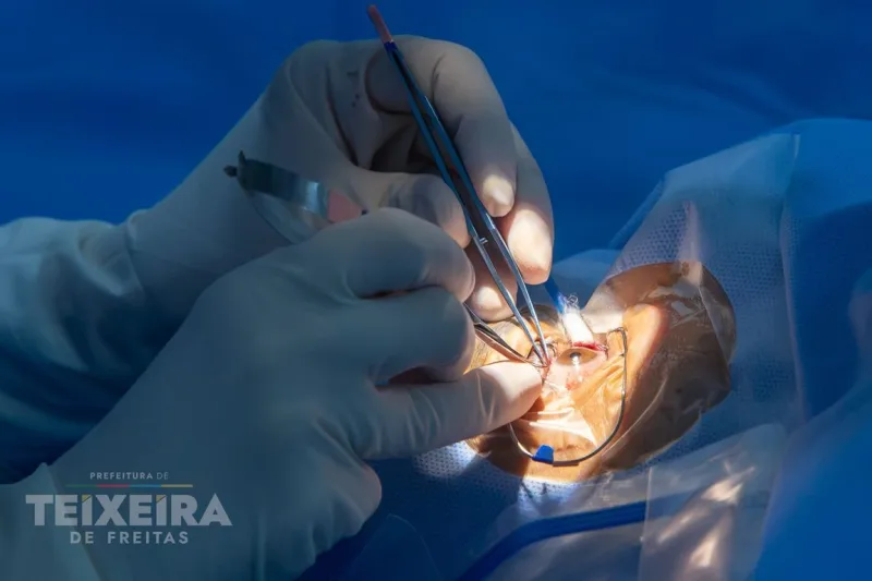 Mais de 160 pacientes recebem tratamento cirúrgico de catarata em Teixeira de Freitas Mais de 160 pacientes recebem tratamento cirúrgico de catarata em Teixeira de Freitas