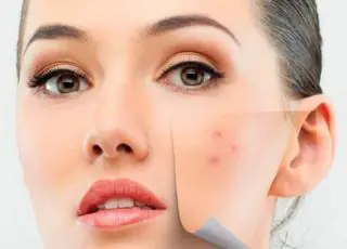 5 dicas para amenizar os efeitos causados pela acne