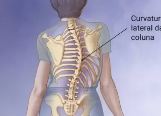 A ESCOLIOSE segundo Dr. Leonardo Felipe. Complicações e tratamentos