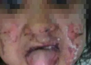 Adolescente passa álcool gel e ateia fogo no rosto da irmã de 7 anos