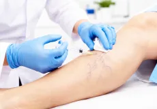 Alcobaça realiza mutirão de escleroterapia para tratamento de varizes e amplia acesso à saúde especializada