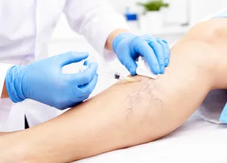 Alcobaça realiza mutirão de escleroterapia para tratamento de varizes e amplia acesso à saúde especializada