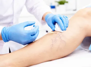 Alcobaça realiza mutirão de escleroterapia para tratamento de varizes e amplia acesso à saúde especializada