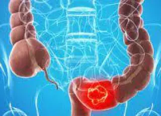 Alteração do hábito intestinal é um dos principais sinais de alerta do câncer colorretal