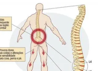 Alterações Posturais , Irradiação das Dores pelo corpo