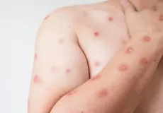 Apenas 01 caso de Mpox  é confirmado na Bahia.  7 casos foram notificados.