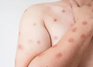 Apenas 01 caso de Mpox  é confirmado na Bahia.  7 casos foram notificados.