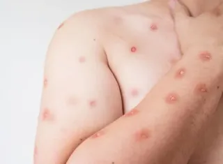 Bahia notifica 7 casos suspeitos de Mpox em 2026; apenas 1 é confirmado 