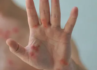 Bahia registra dois casos de Mpox em 2026; pacientes estão em acompanhamento