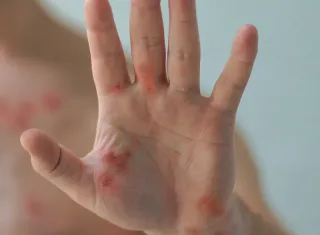 Bahia registra dois casos de Mpox em 2026; pacientes estão em acompanhamento