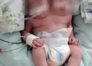 Bebê com duas cabeças nasce no interior de São Paulo