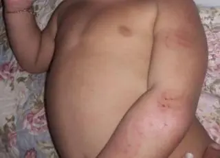 Bebê de 1 ano é agredido com 14 mordidas dentro de creche particular