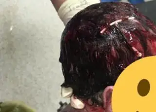 Bebê nasce com DIU preso no cabelo e foto viraliza!