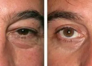 Blefaroplastia é uma das cirurgias plásticas mais realizadas pelos homens