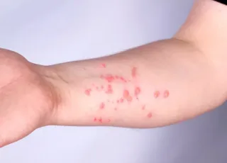 Brasil registra 140 casos confirmados de Mpox em 2026, aponta Ministério da Saúde