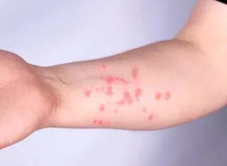 Brasil registra 140 casos confirmados de Mpox em 2026, aponta Ministério da Saúde