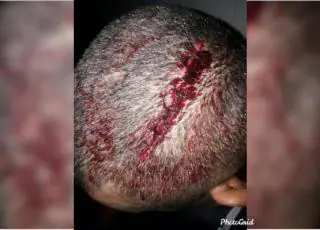 Briga entre cunhados deixa um ferido a facãozadas em Medeiros Neto