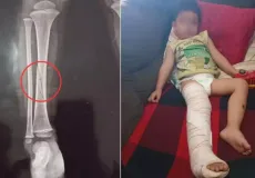 Briga por brinquedo em creche termina com menino com a perna quebrada