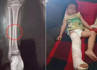 Briga por brinquedo em creche termina com menino com a perna quebrada
